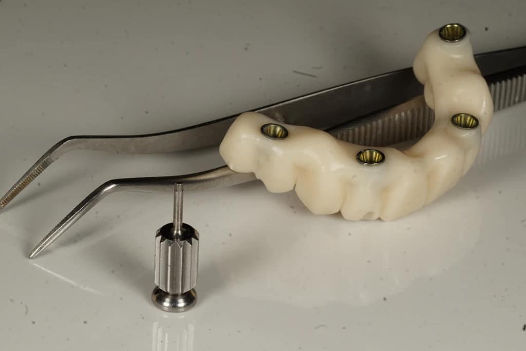 Verschraubte Full-Arch-Implantatbrücke mit Schraubenkanälen und Prothetik-Schraubendreher, Ulubey Dental Clinic