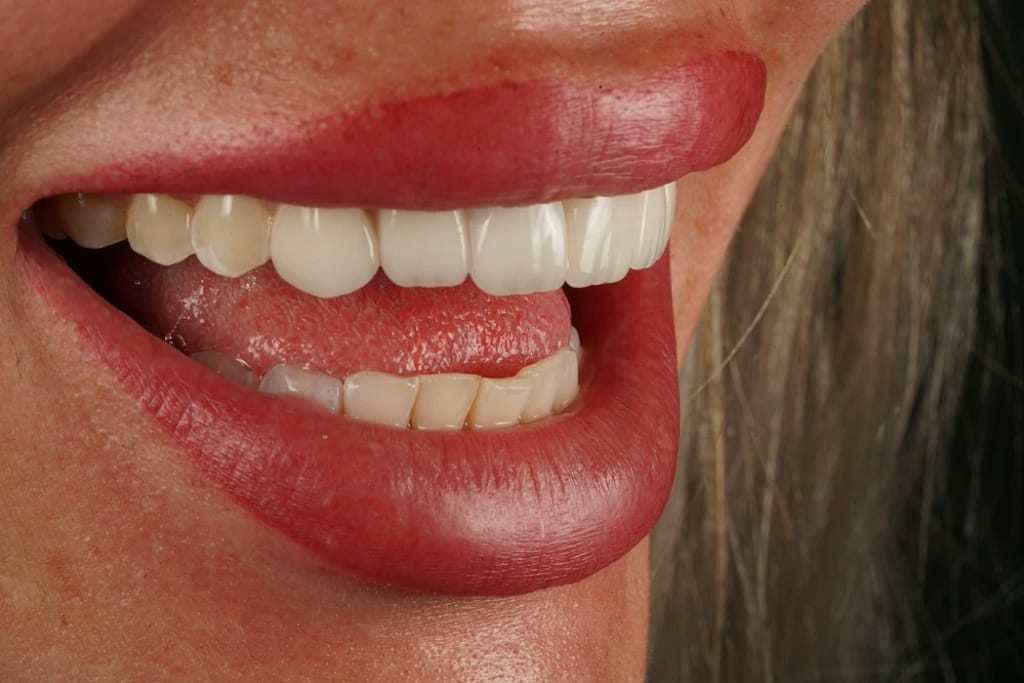 Keramik-Veneers nach der adhäsiven Befestigung – Nahaufnahme des Lächelns, Ulubey Dental Clinic, Antalya