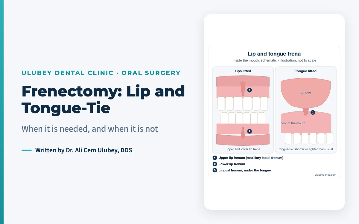 Featured image: frenectomy, with a schematic of the lip and tongue frena