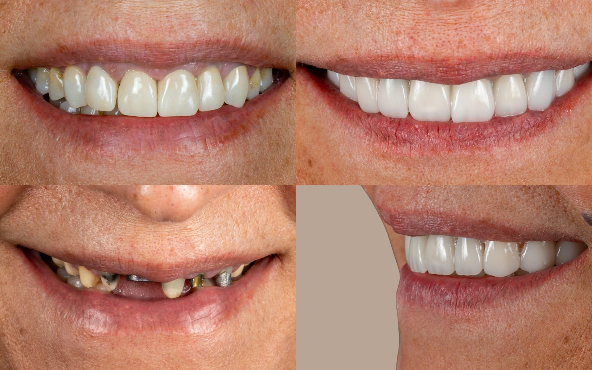 Hollywood smile transformation with Ivoclar IPS e.max veneers at Ulubey Dental Clinic, Antalya — before and after case study