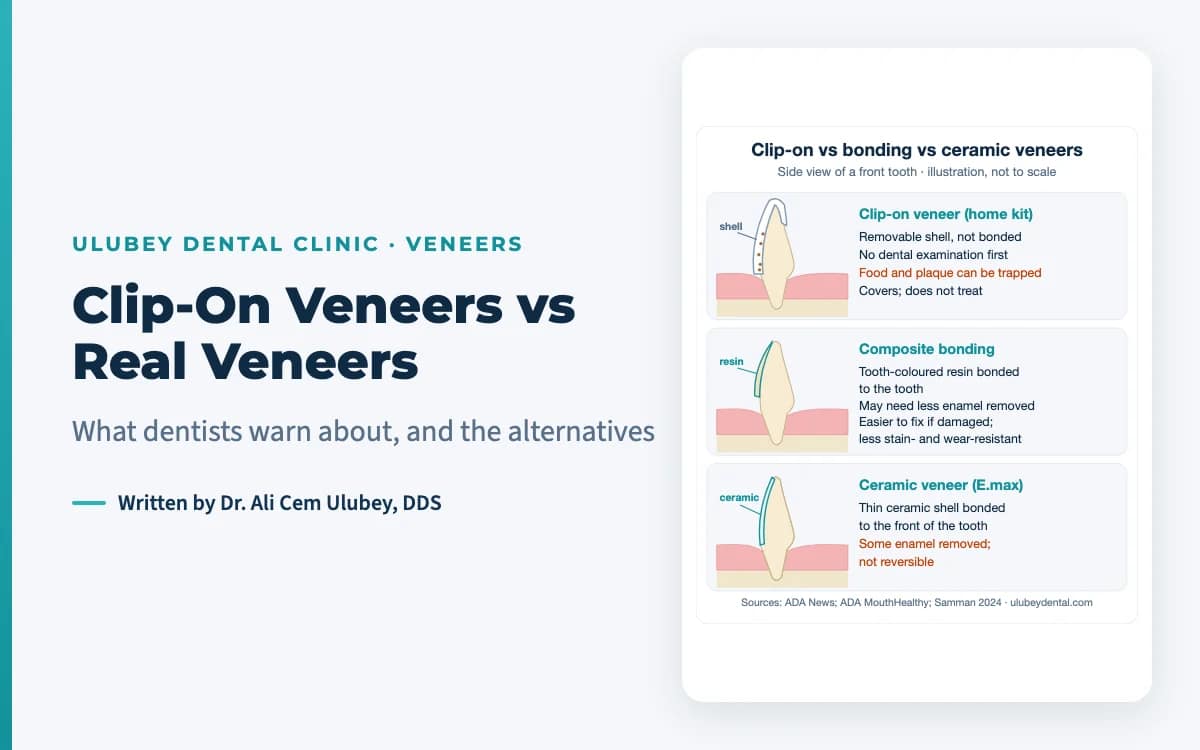 Featured image: clip-on veneers vs real veneers, side view of a front tooth