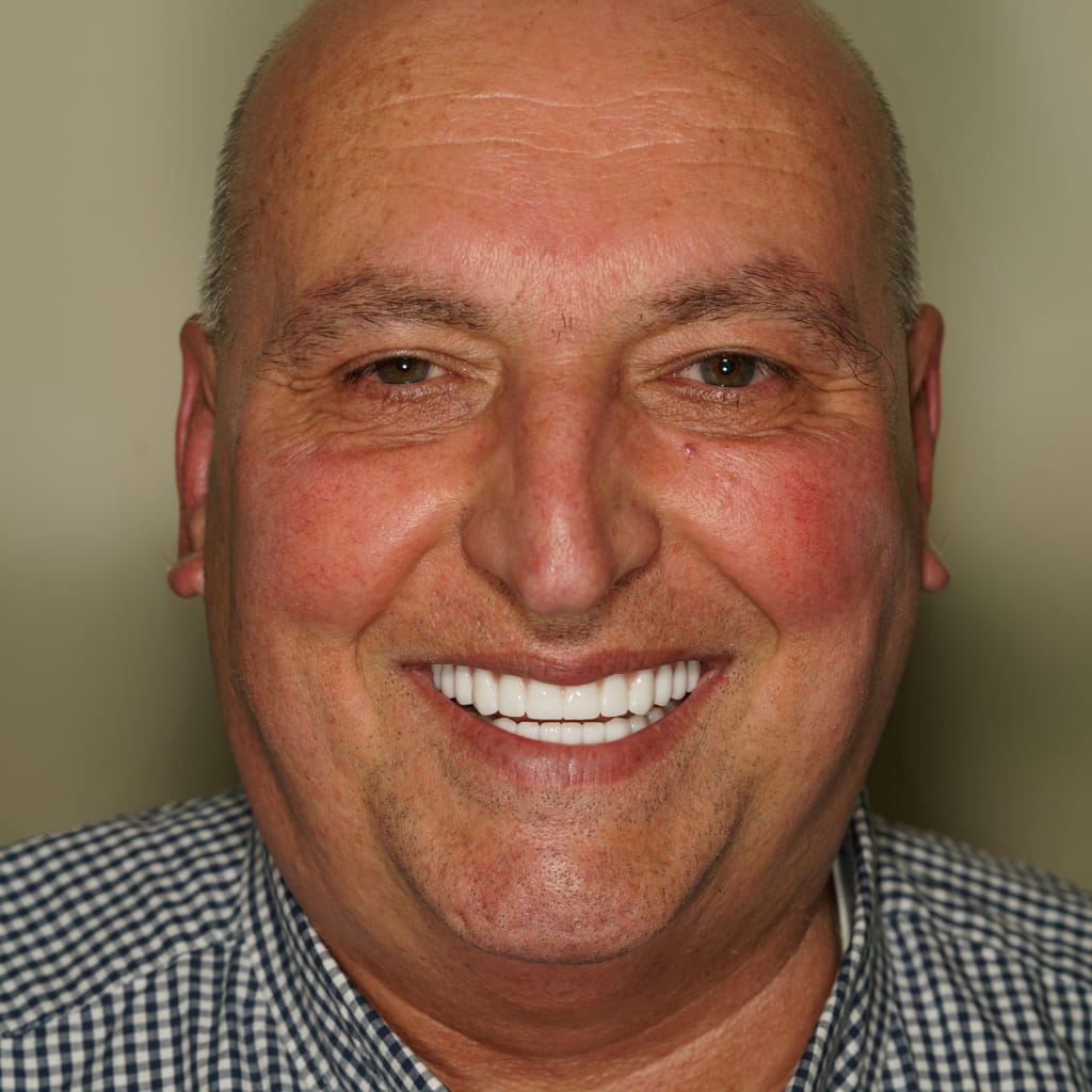 Patient testimonial — Mahmut Cengiz All-on-X dental implant treatment at Ulubey Dental Clinic
