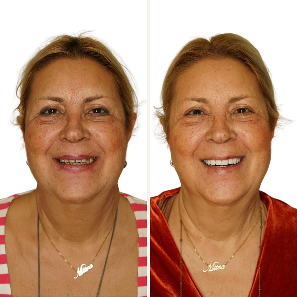 Mitra Vahedi, patient at Ulubey Dental Clinic Antalya before her full mouth reconstruction