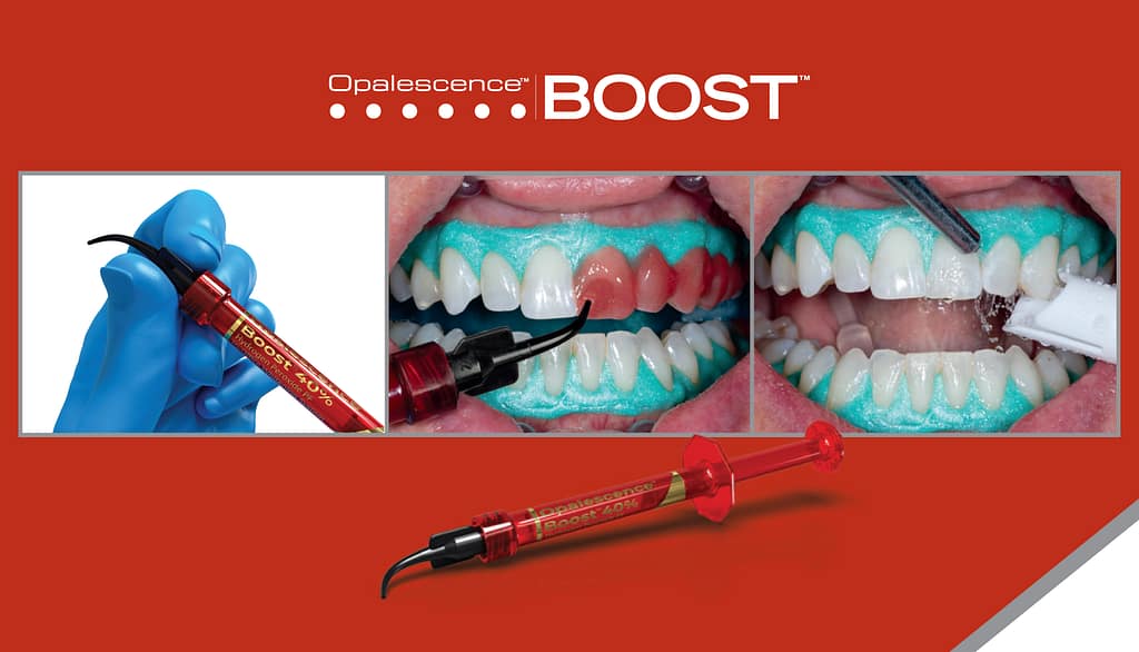 Opalescence in-clinic whitening Antalya