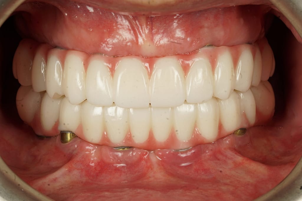 Ulubey Dental Clinic — All-on-4 treatment in progress with digital workflow