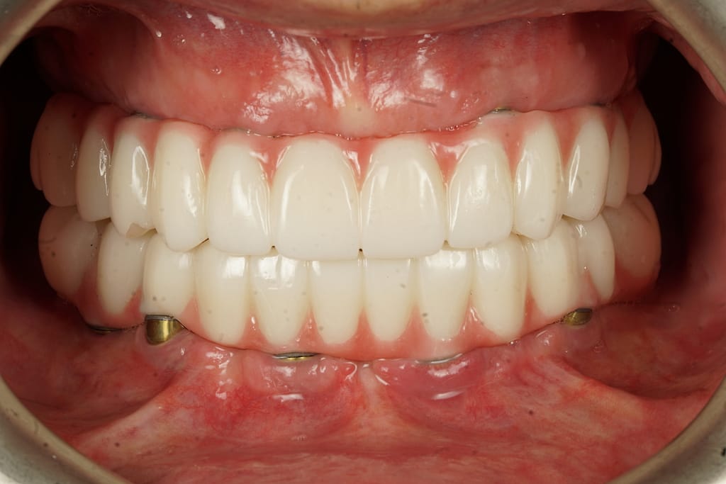 Ulubey Dental Clinic — all on 4 treatment photo