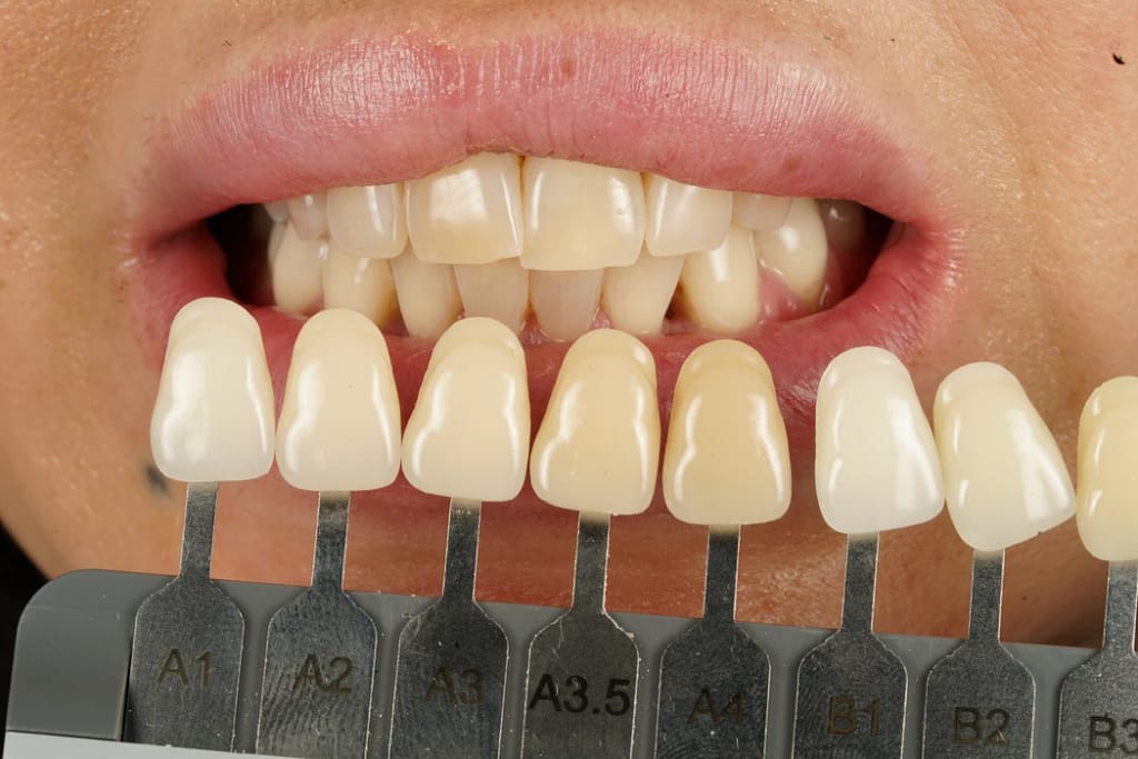In-clinic shade evaluation using the VITA Classical guide at Ulubey Dental Clinic to calibrate natural enamel value and chroma.