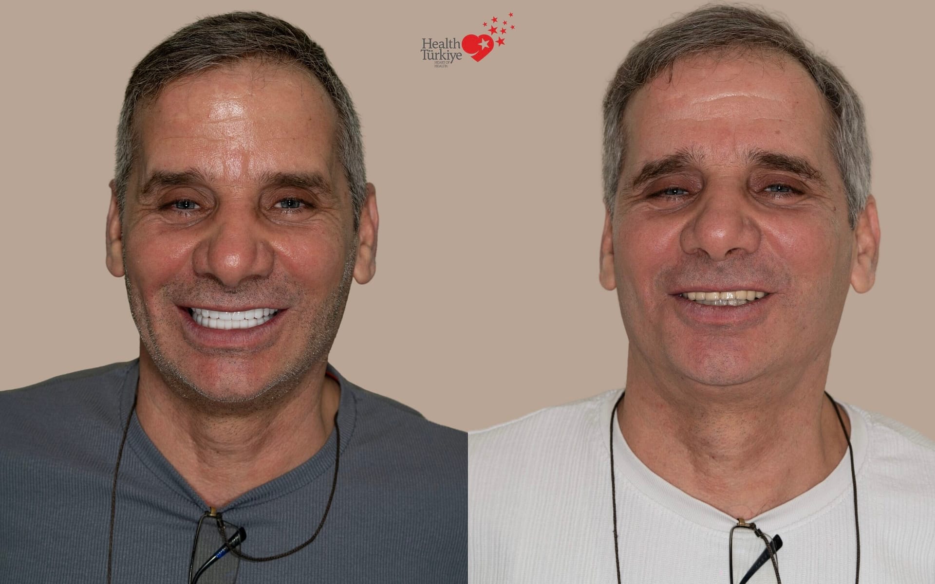 Turkey teeth gone wrong — how to spot and avoid it, Ulubey Dental Clinic Antalya
