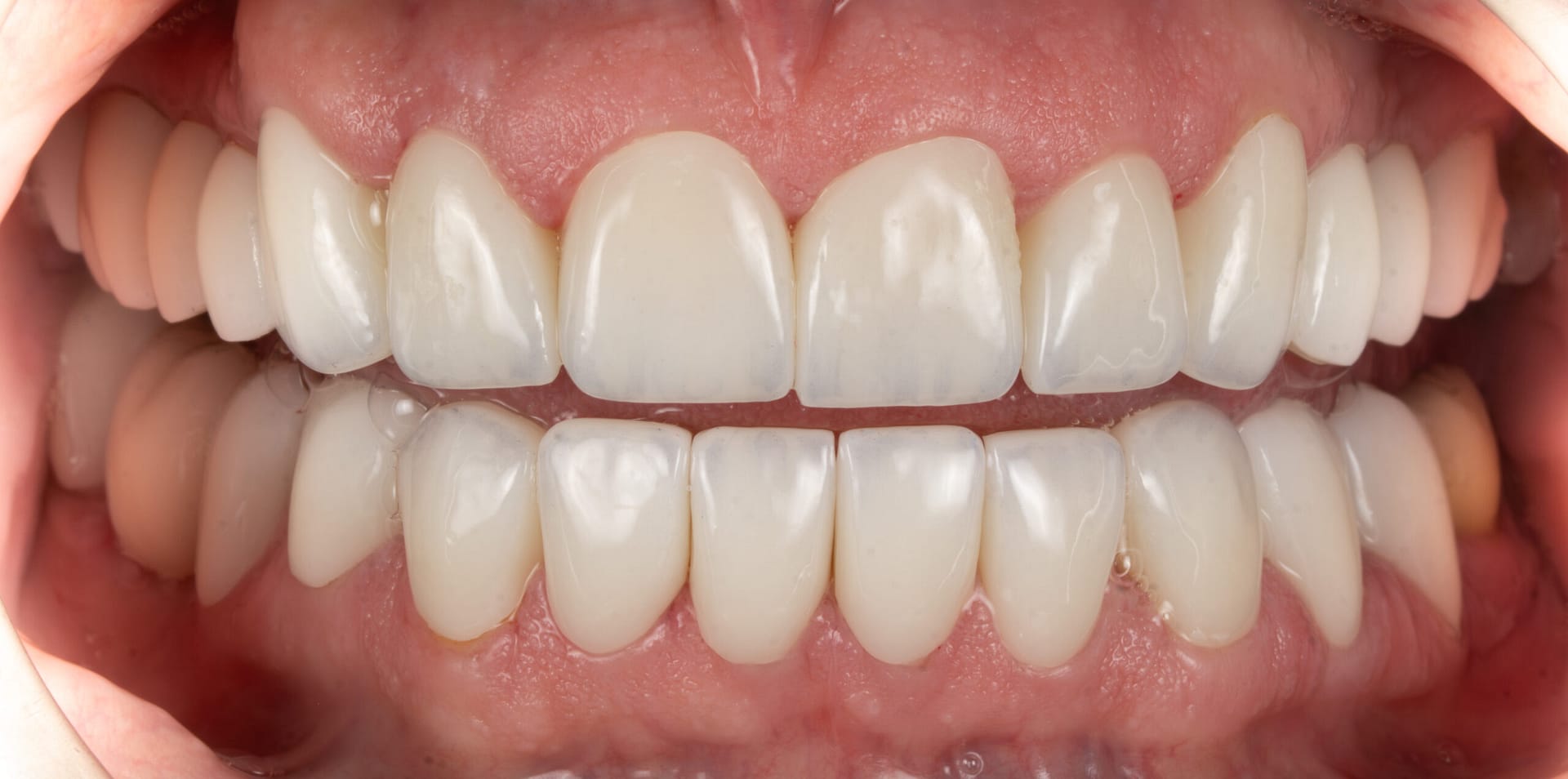 Ulubey Dental Clinic — full mouth restoration treatment photo