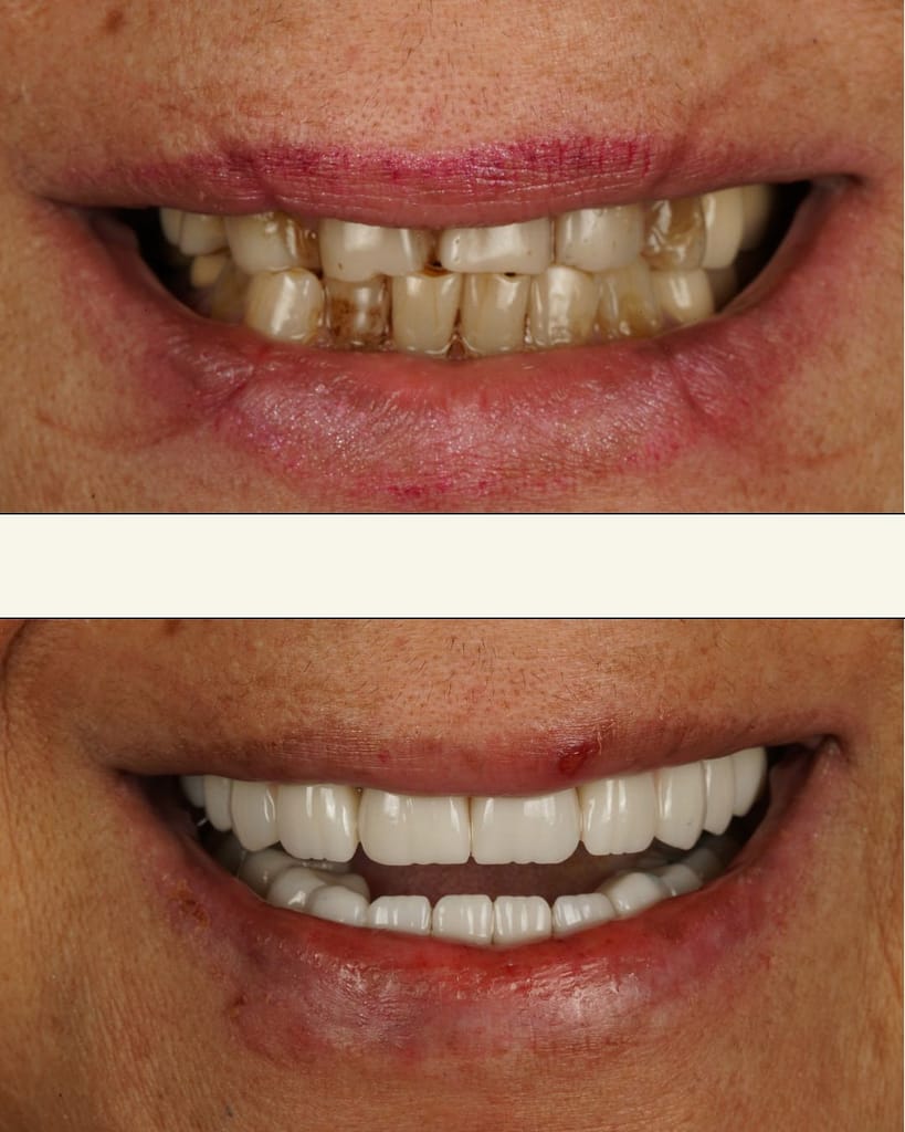 Close-up of Mitra Vahedi's smile after full mouth reconstruction with zirconia crowns at Ulubey Dental Clinic Antalya